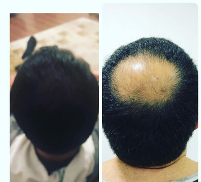 Slider image (3) Fuller Hair Transplant Clinic